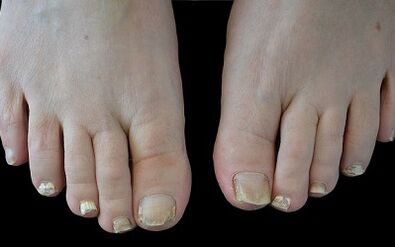 Kuidas vabaneda sõrmede seenest