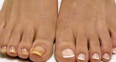 Laevastiku seene ravimeetodid