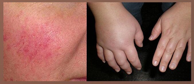 Tilkade kõrvaltoimed